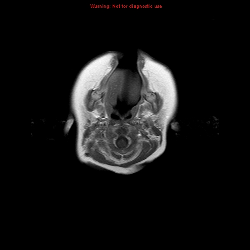 File:Atypical teratoid rhabdoid tumor (Radiopaedia 10712-11183 Axial T1 C+ 19).jpg