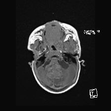 Atypical teratoid rhabdoid tumor (prenatal US and neonatal MRI) (Radiopaedia 59091-66388 Axial T1 12).jpg