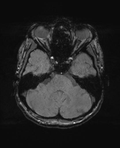 Autoimmune limbic encephalitis (Radiopaedia 30363-31005 SWI - magnitude 20).jpg