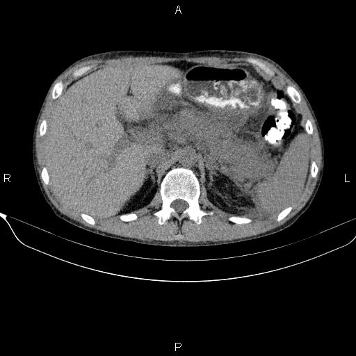 Autoimmune pancreatitis (Radiopaedia 84925-100431 Axial non-contrast 18).jpg