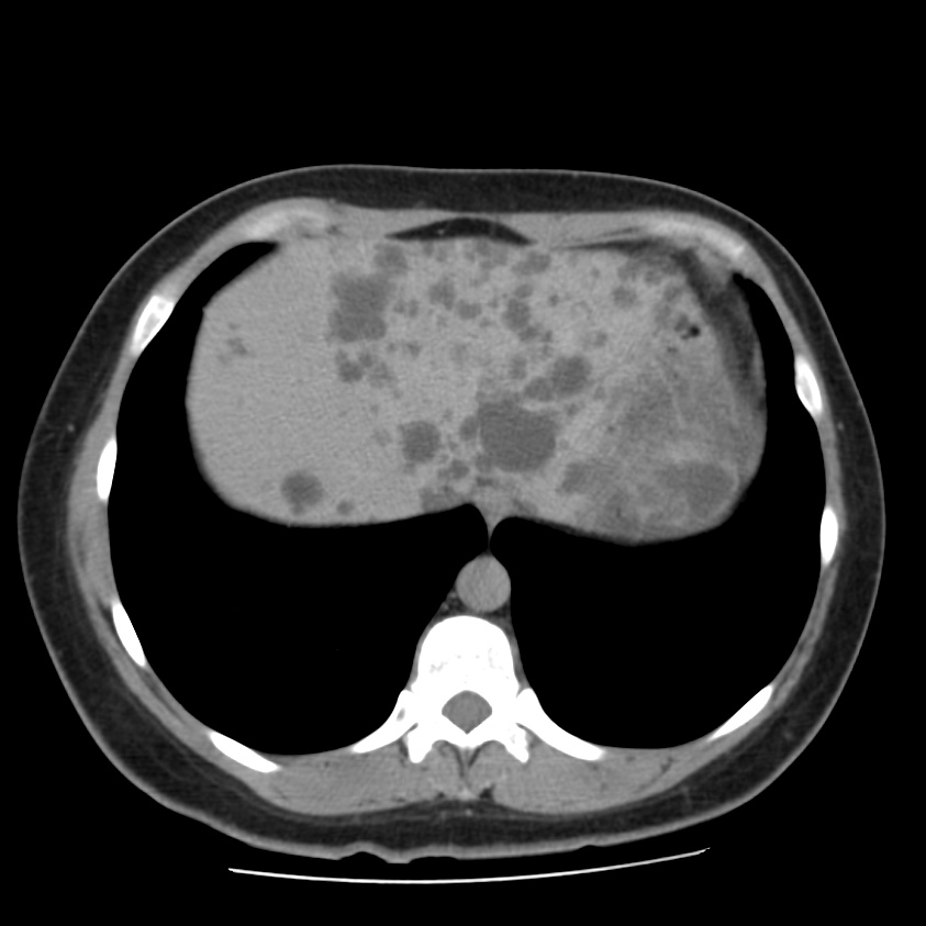 Autosomal dominant polycystic kidney disease (Radiopaedia 23061-23093 C+ delayed 9).jpg