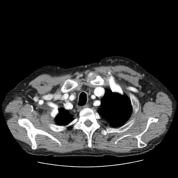 Autosomal dominant polycystic kidney disease (Radiopaedia 27851-28094 B 8).jpg