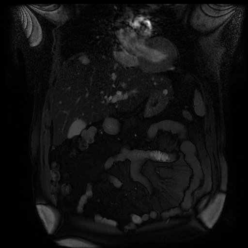 File:Autosomal dominant polycystic kidney disease (Radiopaedia 50259-55611 Coronal FIESTA 12).jpg