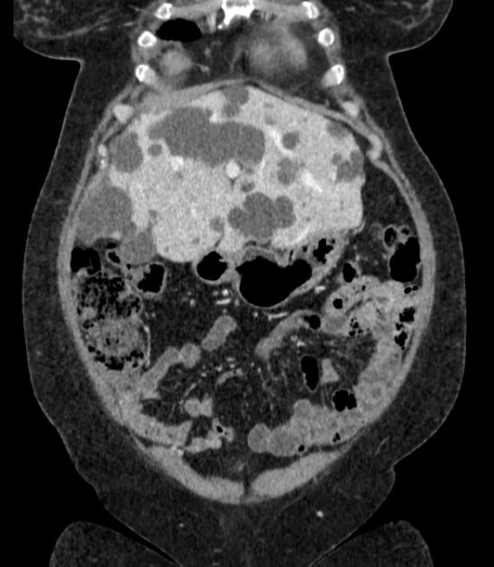 Autosomal dominant polycystic kidney disease (Radiopaedia 57124-64017 B 19).jpg