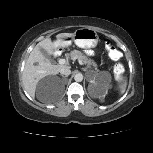 Autosomal dominant polycystic kidney disease with hepatic involvement (Radiopaedia 32693-33662 B 23).jpg