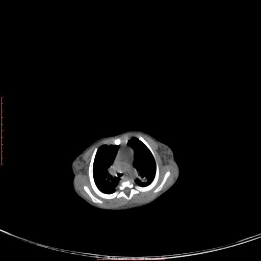 File:Autosomal recessive polycystic kidney disease associated with Caroli disease (Radiopaedia 61932-69984 B 33).jpg