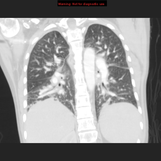 File:Avascular necrosis in sickle cell disease (Radiopaedia 17448-17152 B 84).jpg