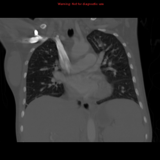 File:Avascular necrosis in sickle cell disease (Radiopaedia 17448-17152 Coronal bone window 63).jpg