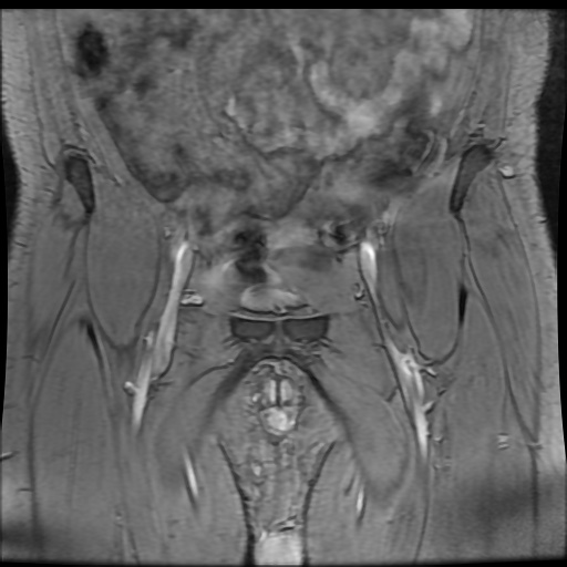 Avascular necrosis of the hip (Radiopaedia 61503-69465 F 7).jpg