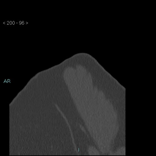 Avascular necrosis of the shoulder - Cruess stage I (Radiopaedia 77674-89887 Sagittal bone window 95).jpg