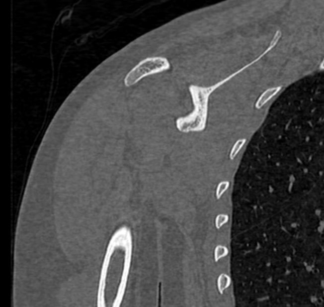 Avulsion fracture - greater tuberosity of humerus (Radiopaedia 71216-81514 Coronal bone window 44).jpg
