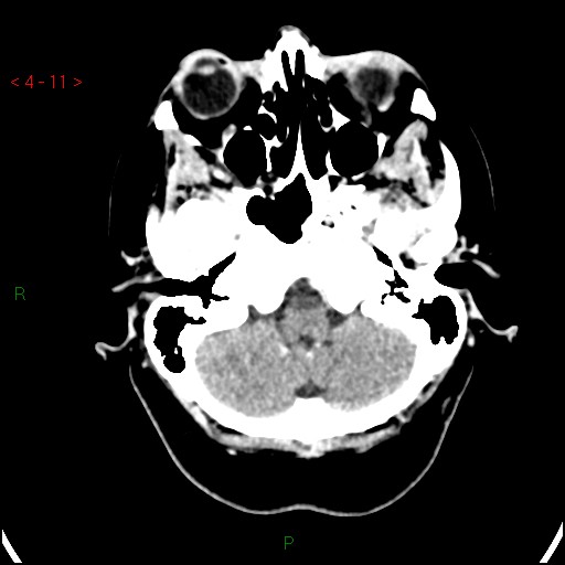 Azygos anterior cerebral artery (Radiopaedia 51987-57833 A 11).jpg
