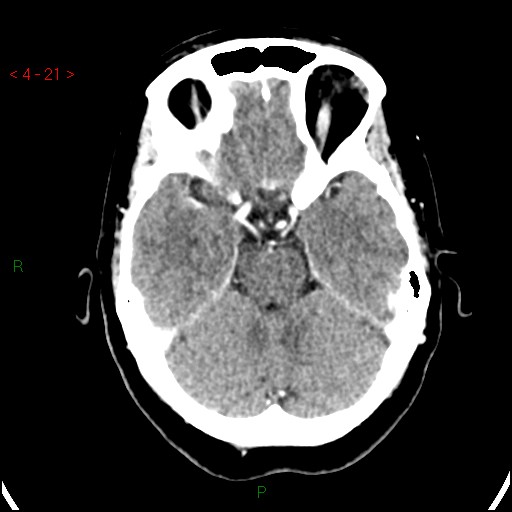 Azygos anterior cerebral artery (Radiopaedia 51987-57833 A 21).jpg