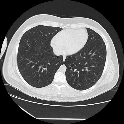 Azygos fissure (Radiopaedia 88181-104784 Axial lung window 37).jpg