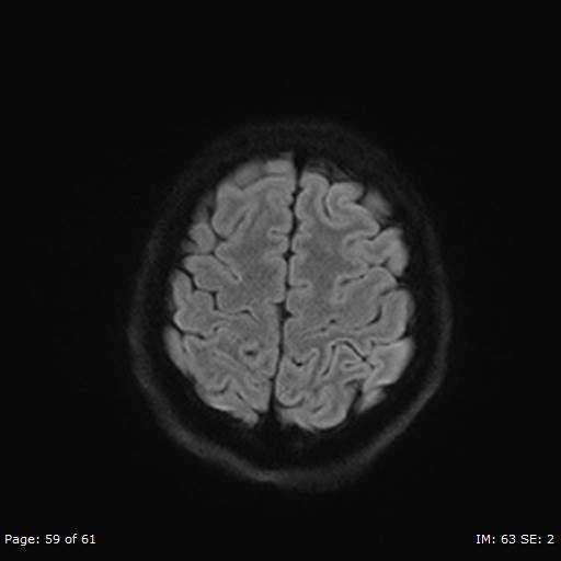Balo concentric sclerosis (Radiopaedia 61637-69636 I 365).jpg