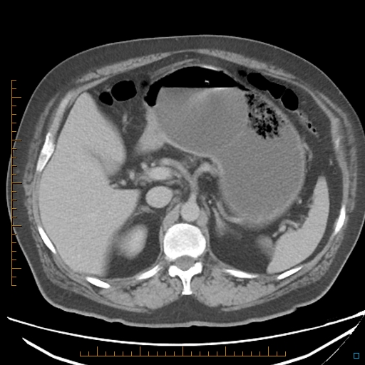 File:Bariatric balloon causing gastric outlet obstruction (Radiopaedia 54449-60672 A 13).jpg