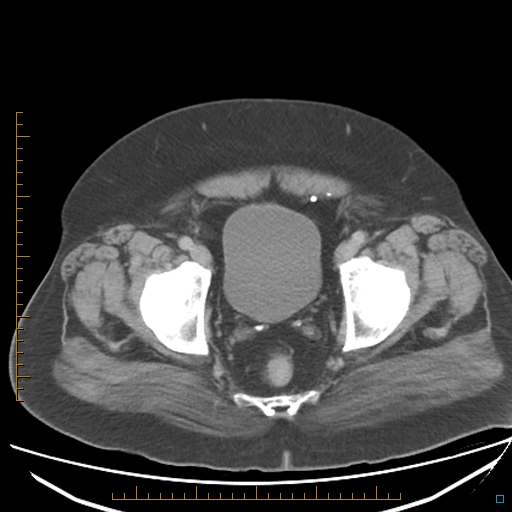 File:Bariatric balloon causing gastric outlet obstruction (Radiopaedia 54449-60672 A 39).jpg
