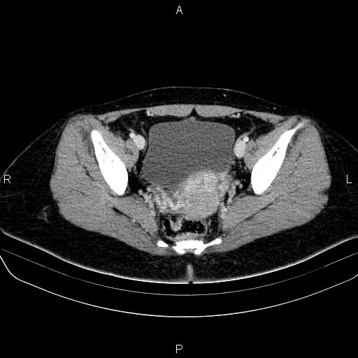 File:Bartholin gland cyst (Radiopaedia 62635-70930 Axial Post contrast 48).jpg