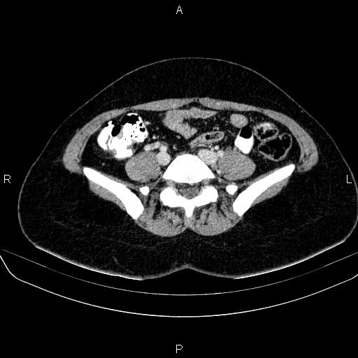File:Bartholin gland cyst (Radiopaedia 62635-70930 Axial Post contrast 8).jpg
