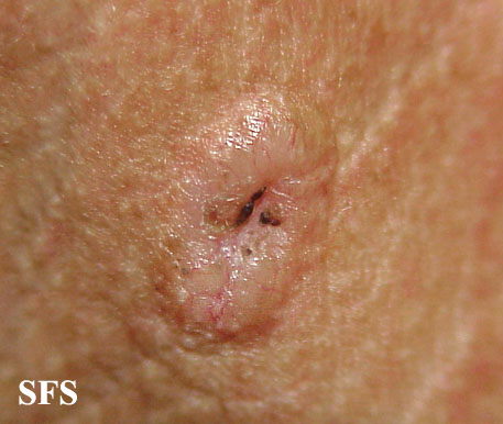Basal Cell Carcinoma (Dermatology Atlas 152).jpg