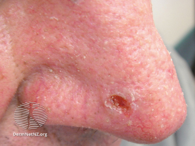 File:Basal cell carcinoma affecting the nose (DermNet NZ lesions-bcc-nose-1112).jpg