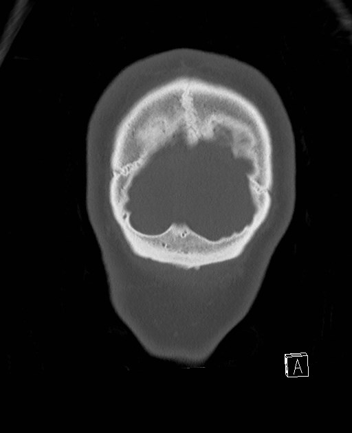 Base of skull fracture with bilateral Le Fort fractures (Radiopaedia 47094-51638 Coronal bone window 5).jpg