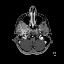 Base of skull rhabdomyosarcoma (Radiopaedia 32196-33142 T1 C+ fat sat 26).jpg