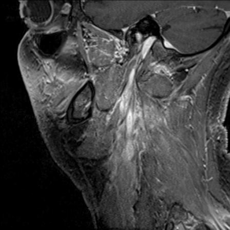 Base of tongue squamous cell carcinoma (Radiopaedia 31174-31884 F 45).jpg