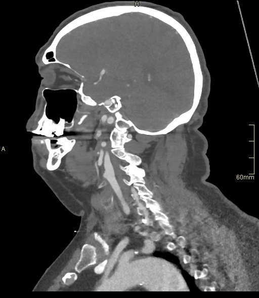 Basilar artery aneurysm (Radiopaedia 56261-62932 C 46).jpg