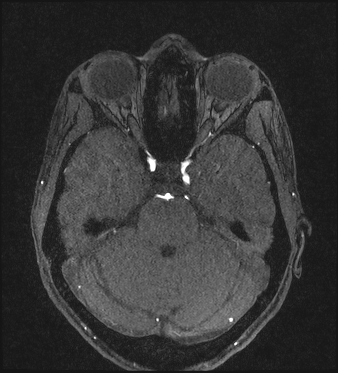 Basilar artery perforator aneurysm (Radiopaedia 82455-97733 Axial MRA 86).jpg