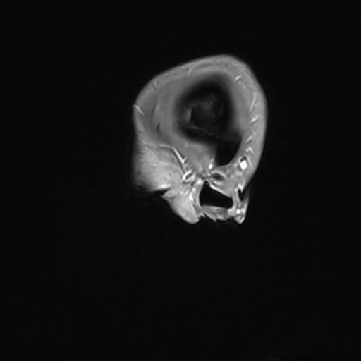Basilar artery perforator aneurysm (Radiopaedia 82455-97733 G 10).jpg