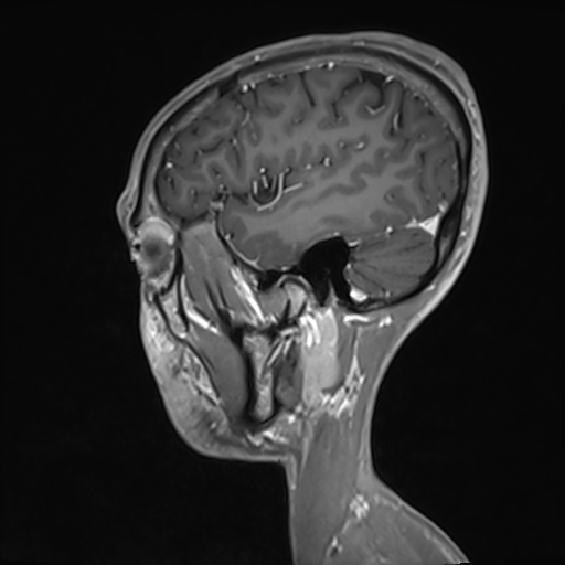 Basilar artery perforator aneurysm (Radiopaedia 82455-97733 G 118).jpg