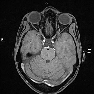 Basilar artery perforator aneurysm (Radiopaedia 82455-99523 F 45).jpg