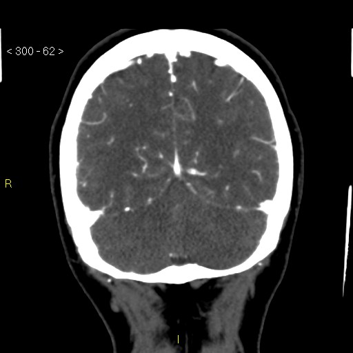 Basilar artery thrombosis (Radiopaedia 16260-15944 B 53).jpg