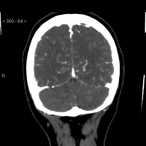 File:Basilar artery thrombosis (Radiopaedia 16260-15944 B 55).jpg