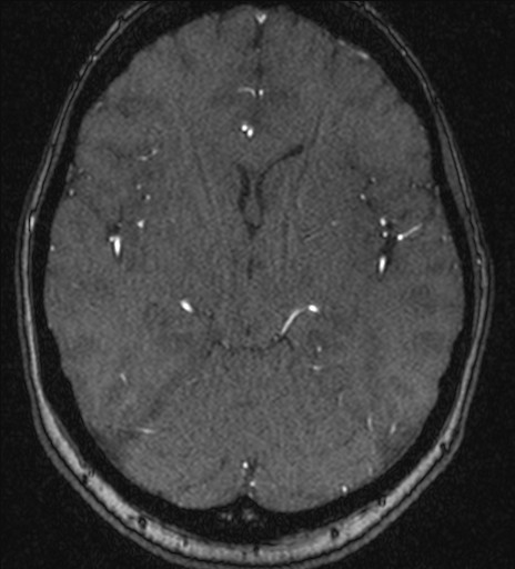 Basilar tip aneurysm (Radiopaedia 26504-26632 MRA 109).jpg