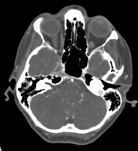 Basilar tip aneurysm with coiling (Radiopaedia 53912-60086 A 38).jpg