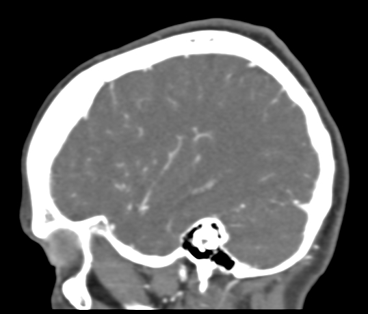 Basilar tip aneurysm with coiling (Radiopaedia 53912-60086 C 104).jpg