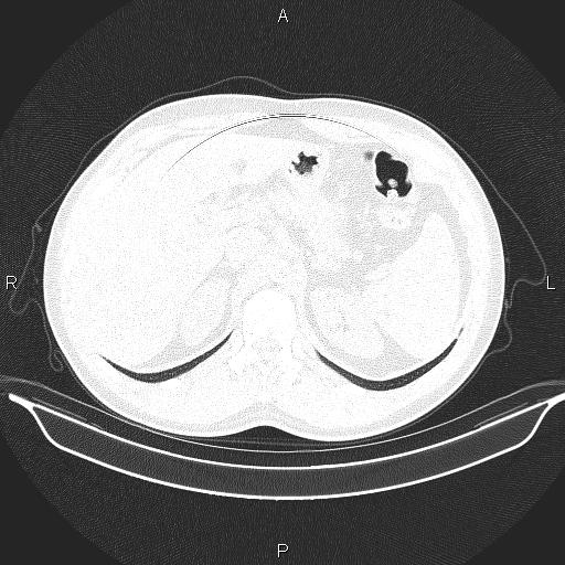 File:Beam hardening and ring artifacts (Radiopaedia 85323-100915 Axial lung window 73).jpg