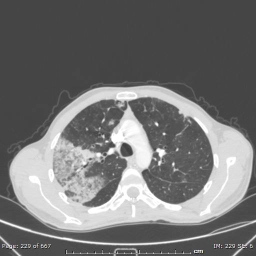 File:Behçet disease (Radiopaedia 44247-47889 Axial lung window 27).jpg