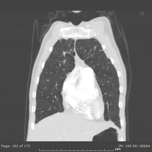 File:Behçet disease (Radiopaedia 44247-47889 Coronal lung window 52).jpg
