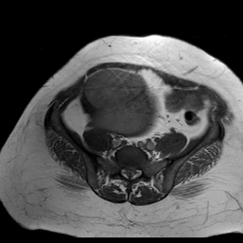 File:Benign seromucinous cystadenoma of the ovary (Radiopaedia 71065-81300 Axial T1 15).jpg