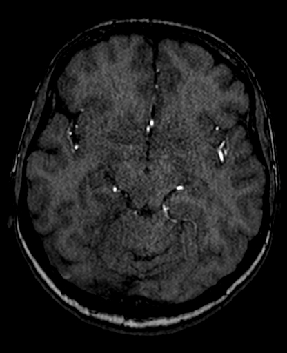 Berry aneurysm of the terminal internal carotid artery (Radiopaedia 88286-104918 Axial TOF 109).jpg