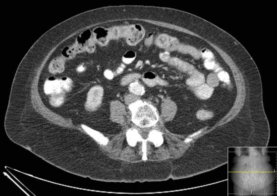 Bicameral celiacomesenteric aneurysm (Radiopaedia 55766-62327 A 38).jpg