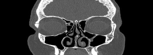 Bilateral Ectopic Infraorbital Nerves (Radiopaedia 49006-54084 Coronal bone window 22).jpg