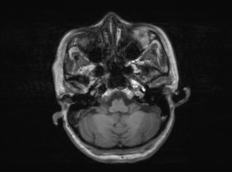 Bilateral PCA territory infarction - different ages (Radiopaedia 46200-51784 Axial T1 317).jpg