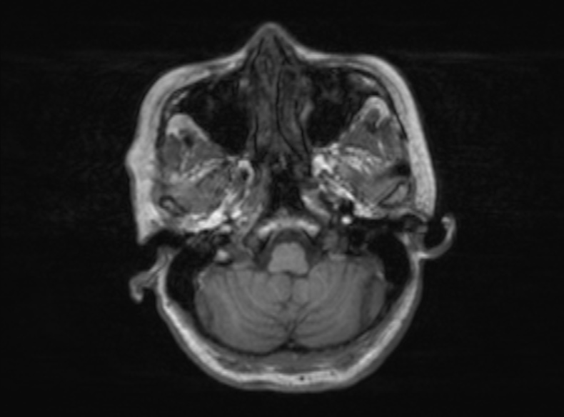 Bilateral PCA territory infarction - different ages (Radiopaedia 46200-51784 Axial T1 326).jpg