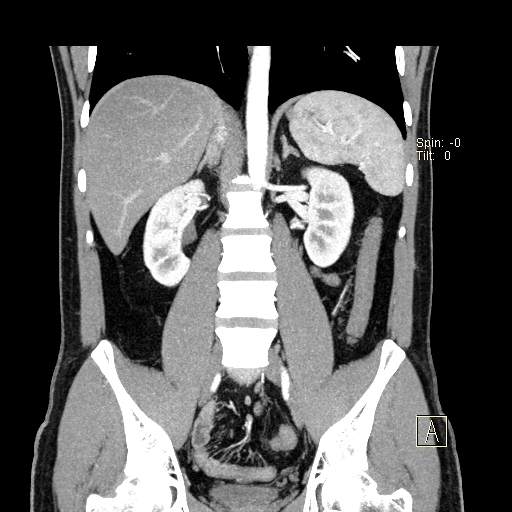 File:Bilateral accessory renal arteries with mild pelvi-ureteric junction (PUJ) obstruction (Radiopaedia 66357-75596 B 26).jpg