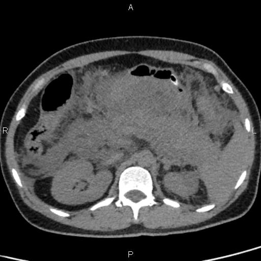 Bilateral adrenal gland hyperenhancement in pancreatitis (Radiopaedia 86642-102753 Axial non-contrast 41).jpg