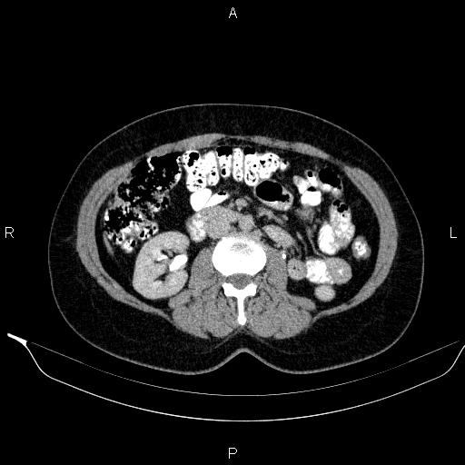 Bilateral adrenal myelolipoma (Radiopaedia 63058-71535 Axial C+ delayed 64).jpg